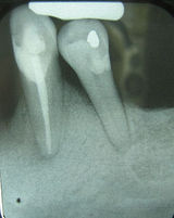 Occlusal trauma