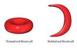 Sickle Cell