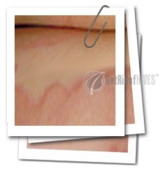 Best Way To Get Rid Of Hives Forever And Ever