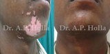 Treatment for Vitiligo New Delhi
