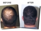 hair clinic bangalore