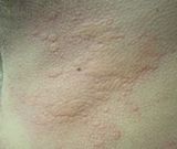 urticaria
