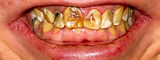 Dental fluorosis
